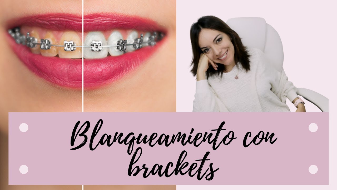 Se puede hacer un 𝗕𝗟𝗔𝗡𝗤𝗨𝗘𝗔𝗠𝗜𝗘𝗡𝗧𝗢 dental con 𝗕𝗥𝗔𝗖𝗞𝗘𝗧𝗦? Tiene alguna Utilidad?
