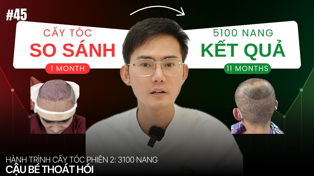 SO SÁNH KẾT QUẢ SAU 11 THÁNG CẤY TÓC #45 l Hành Trình Cấy Tóc