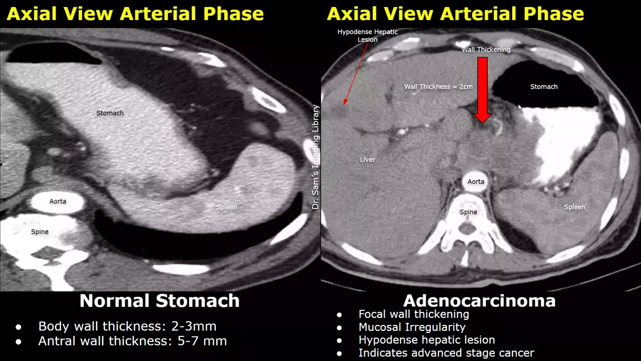 CT Scan Normal Stomach Vs Gastric Adenocarcinoma Images | Early & Advanced Stage Cancer Cases