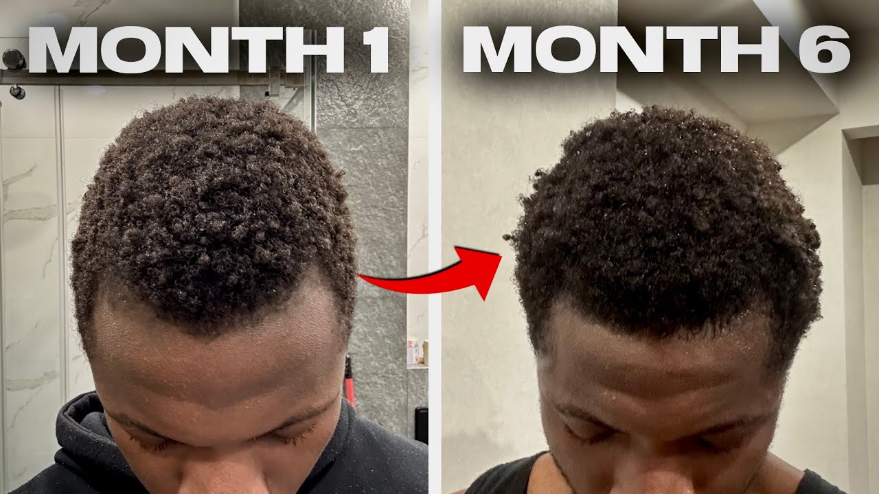Stop Your Hair Loss - What ACTUALLY Works