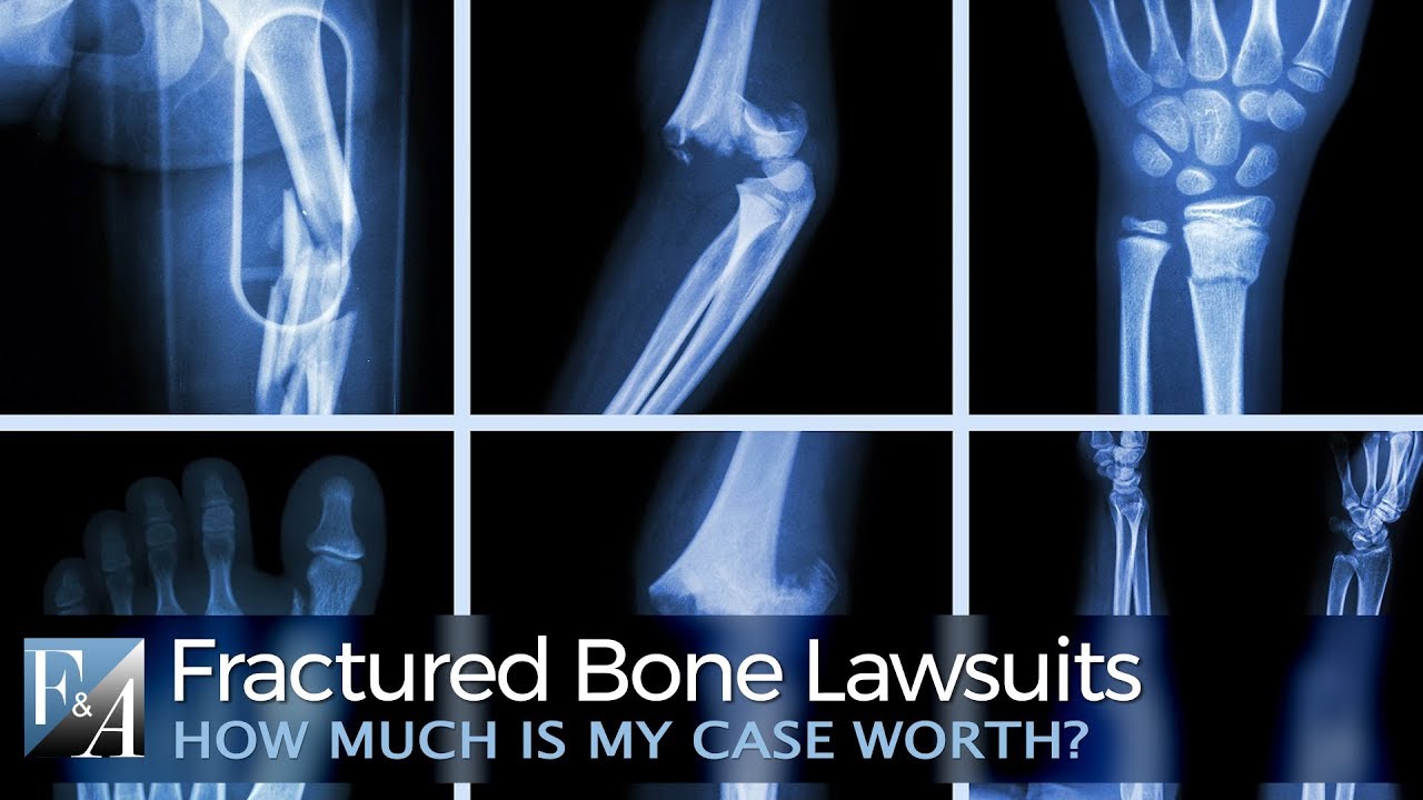 How Much is a Fracture Injury Lawsuit Worth ?