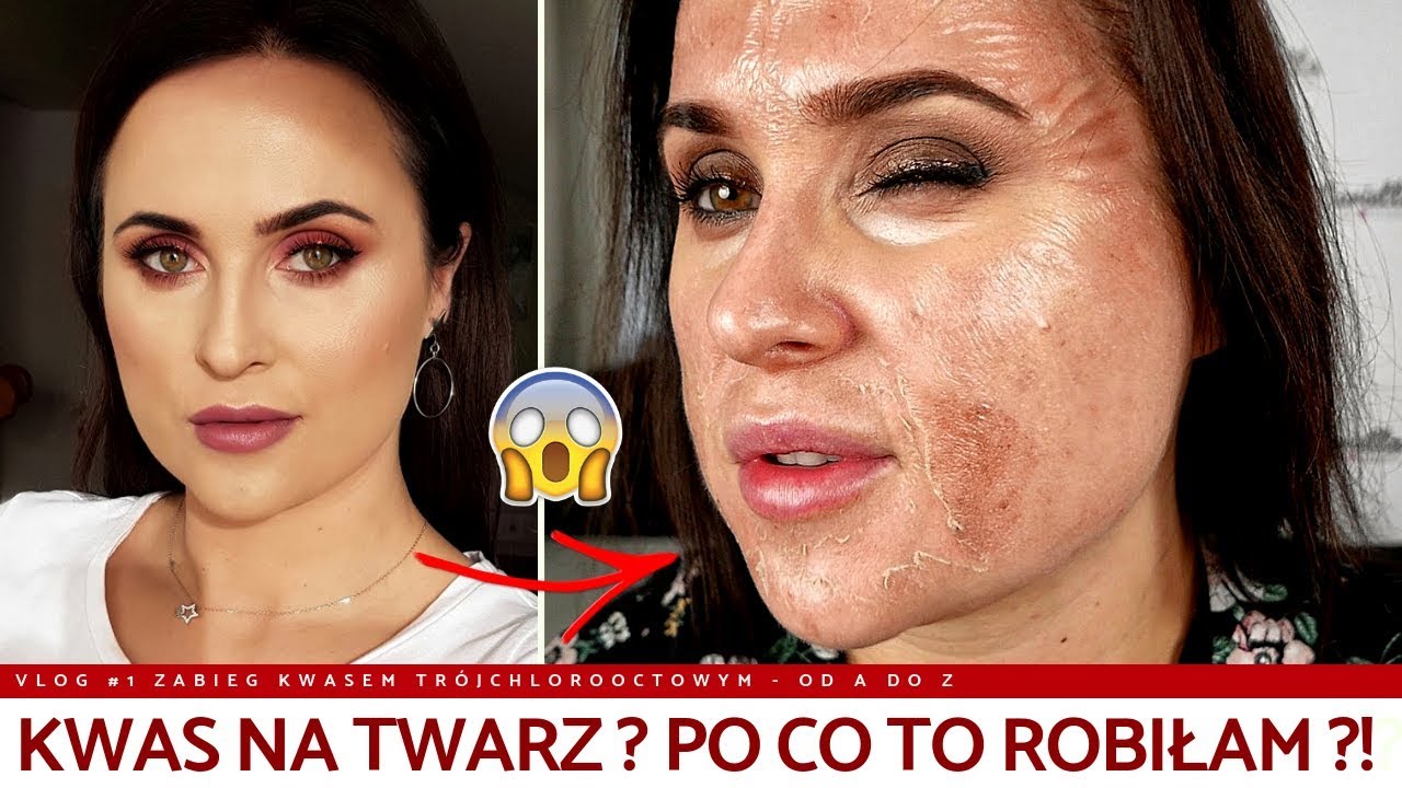 KWASY NA TWARZ - RECENZJA PEELINGU CHEMICZNEGO VLOG