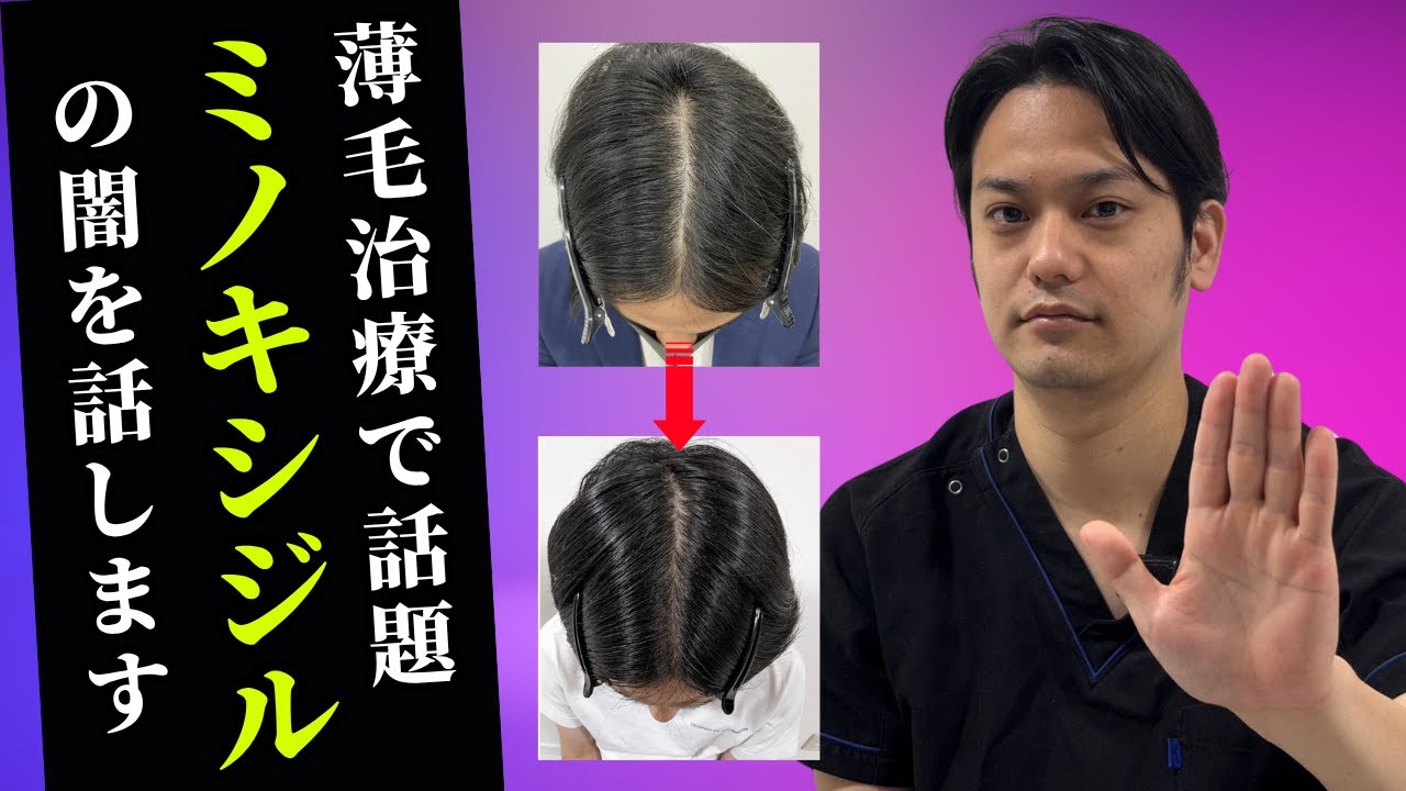 【ミノキシジルの闇】これ知らないと後悔して人生ツミます。