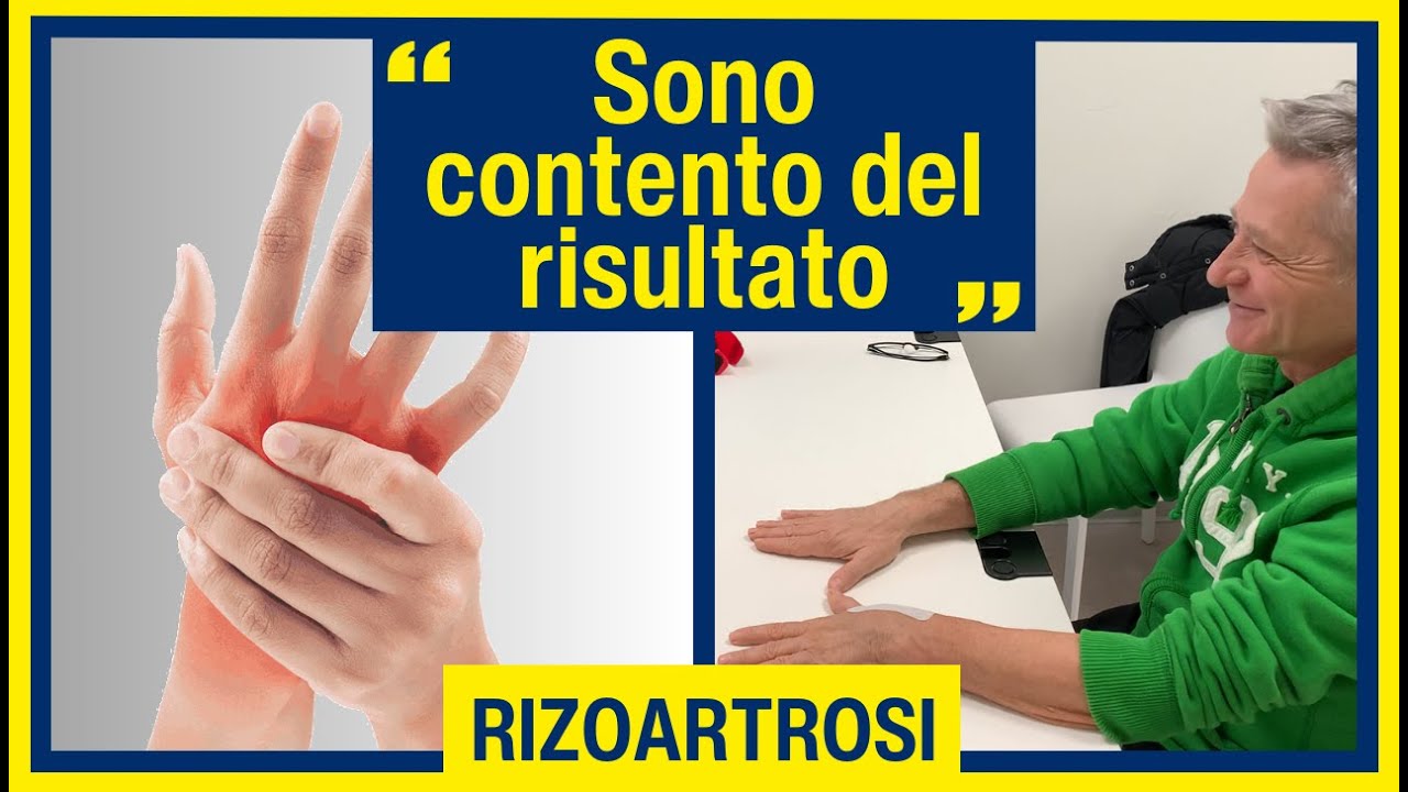Intervento per Rizoartrosi - La testimonianza di Gian Paolo