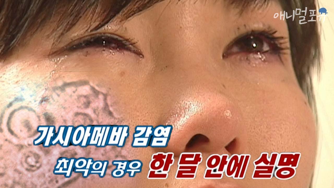 렌즈를 깨끗하게 관리하더라도 이것 때문에 실명할 수 있다고?!ㅣKBS 위기탈출 넘버원 090601 방송