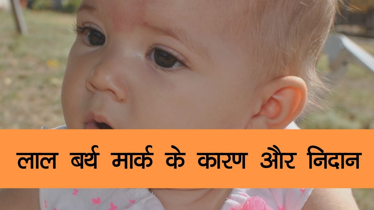 लाल बर्थ मार्क के कारण और निदान - Onlymyhealth.com