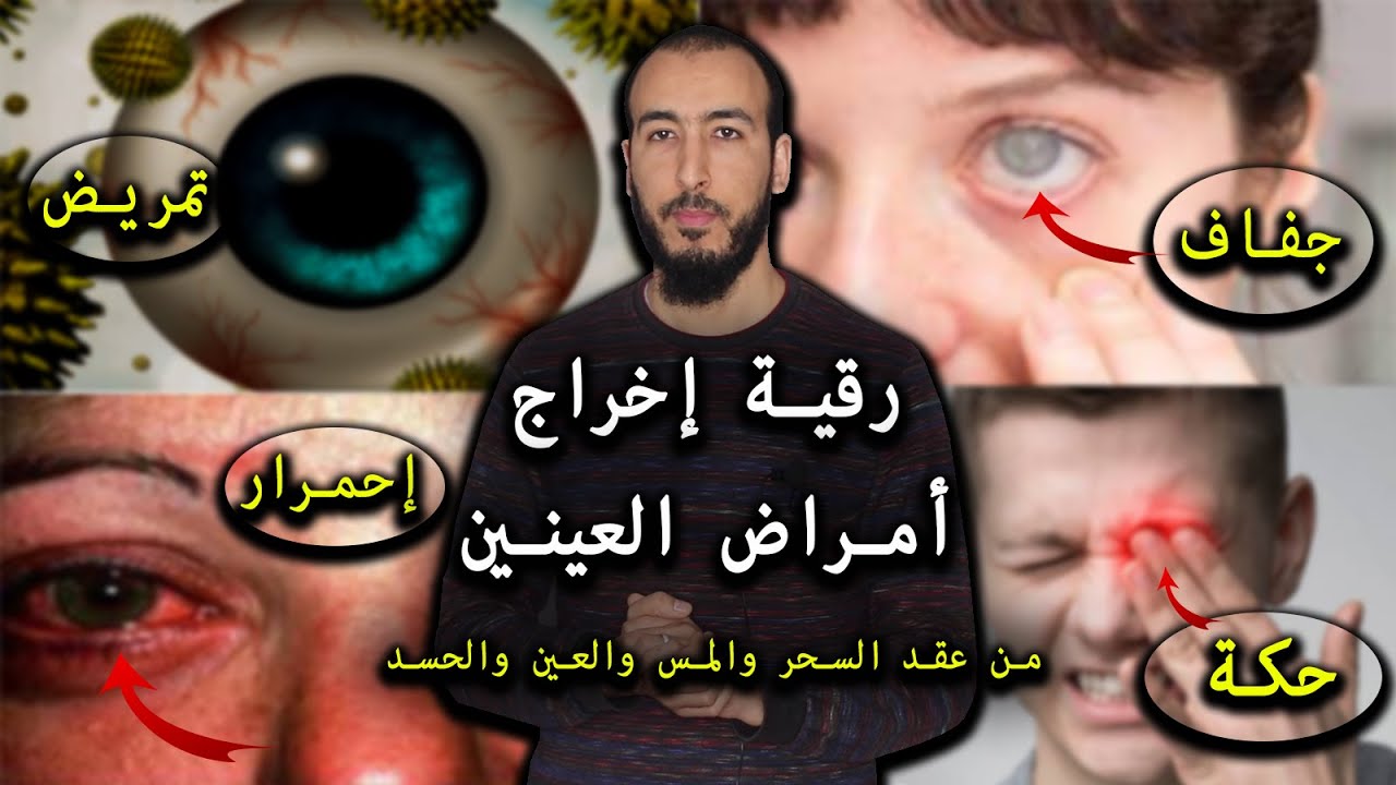 رقية إخراج أمراض العينين الحساسية والإحمرار والحكة والجفاف والحول وتابعة منع شفاء وعلاج العينين