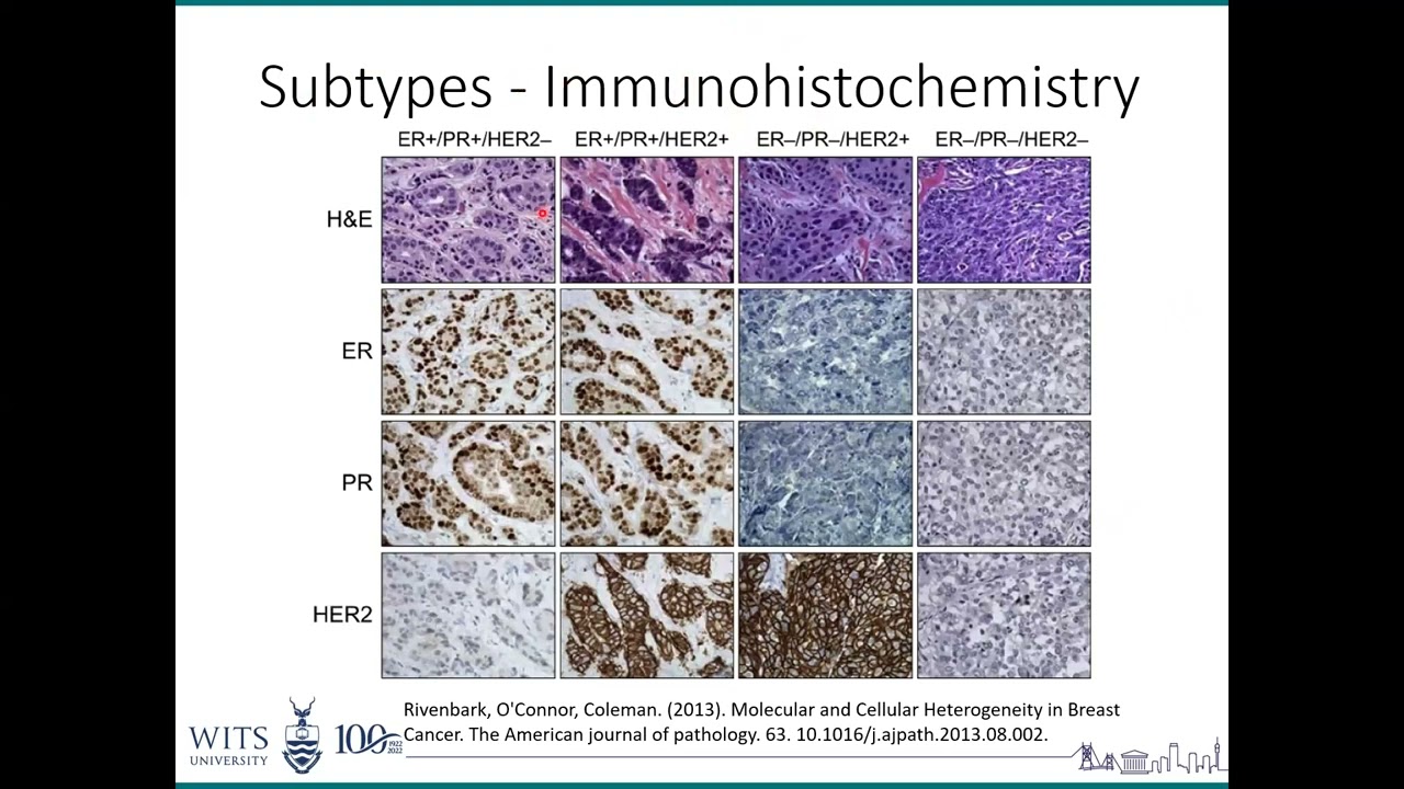 Splicing it together - Breast Cancer, from genes to mechanism