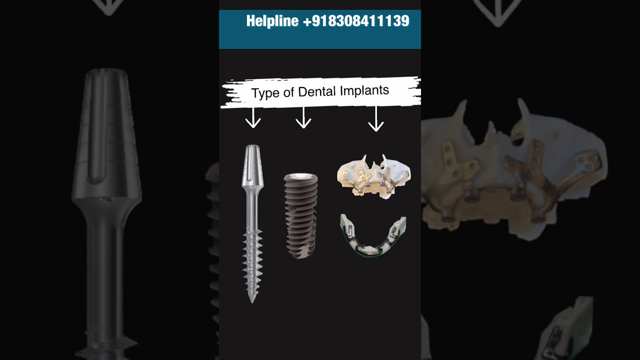 What are 3 types of Dental Implants ? #drmayurkhairnar #fullmouthdentalimplants #dentalimplants