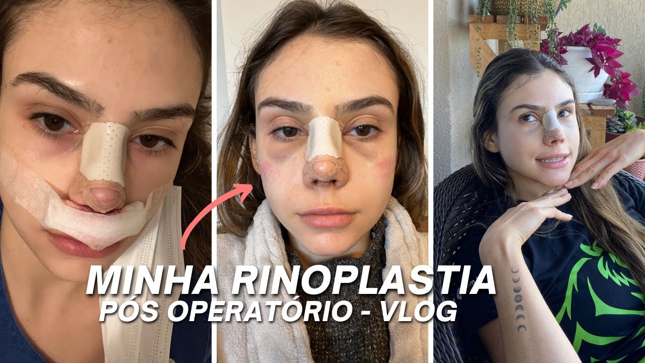 FIZ RINOPLASTIA, PÓS OPERATÓRIO E TIRANDO O CURATIVO - VLOG