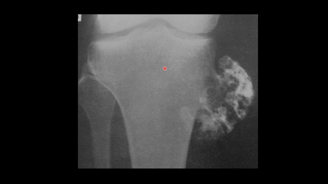 Prof Robert Dunn- Approach to bone tumours