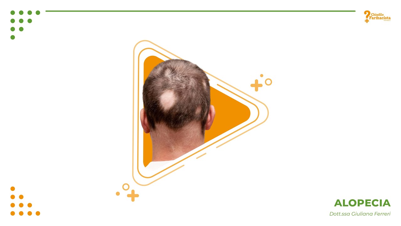 Alopecia, cause e sintomi.