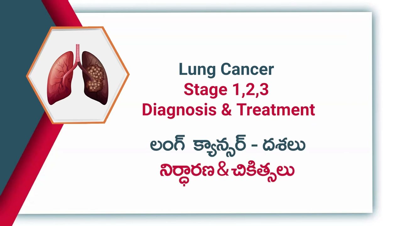 Lung Cancer Stages | Dr. Rahul Narayan Maddi, Oncologist | Prathima Cancer Institute - Warangal