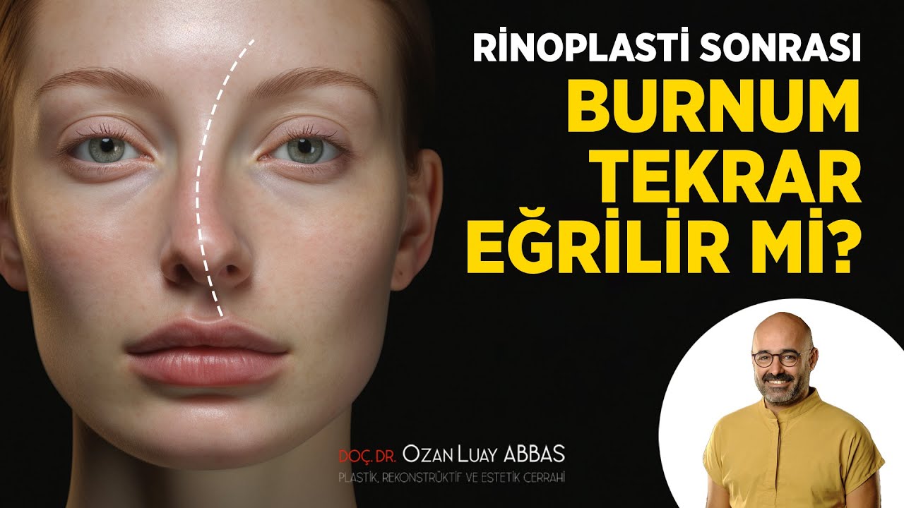 Rinoplasti Sonrası Burnum Tekrar Eğrilir mi? | Doç. Dr. Ozan Luay Abbas