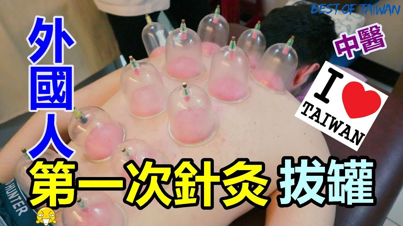 外國人第一次看中醫，第一次體驗拔罐跟針灸! - (老外瘋台灣) (Çin Tıbbı Akupuntur!!)