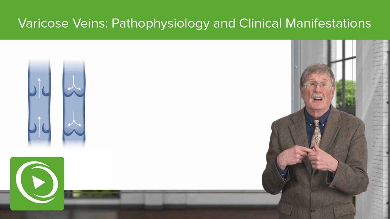 Varicose Veins: Pathophysiology and Clinical Manifestations