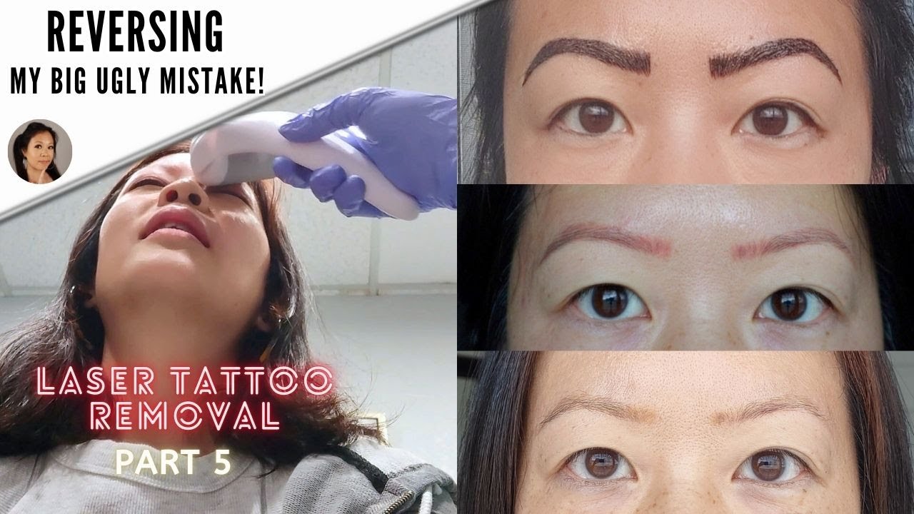 3rd Microblading Removal session: Putting the 532 laser to test-Part 5