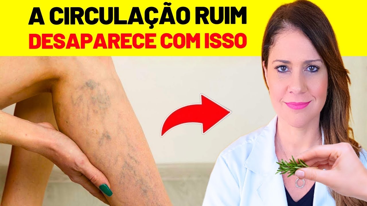 PERNAS PESADAS e VARIZES: O que REALMENTE AJUDA a MELHORAR a CIRCULAÇÃO
