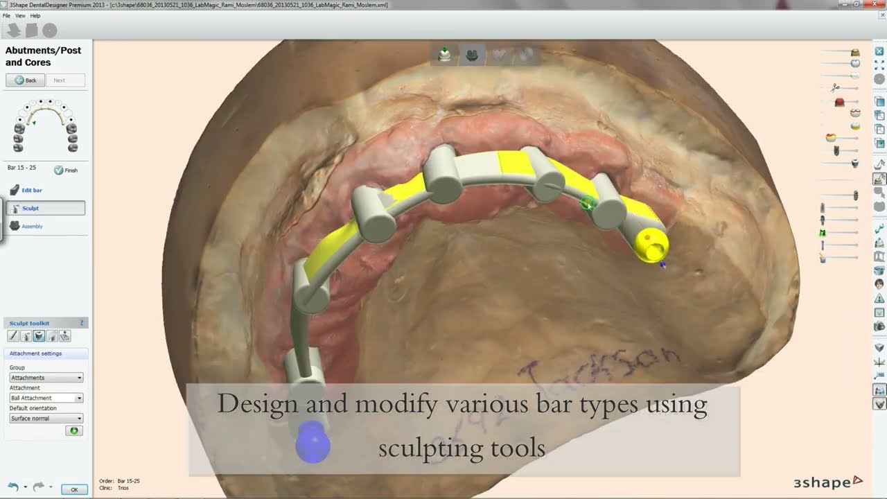 How to design an Implants Bar in 3Shape