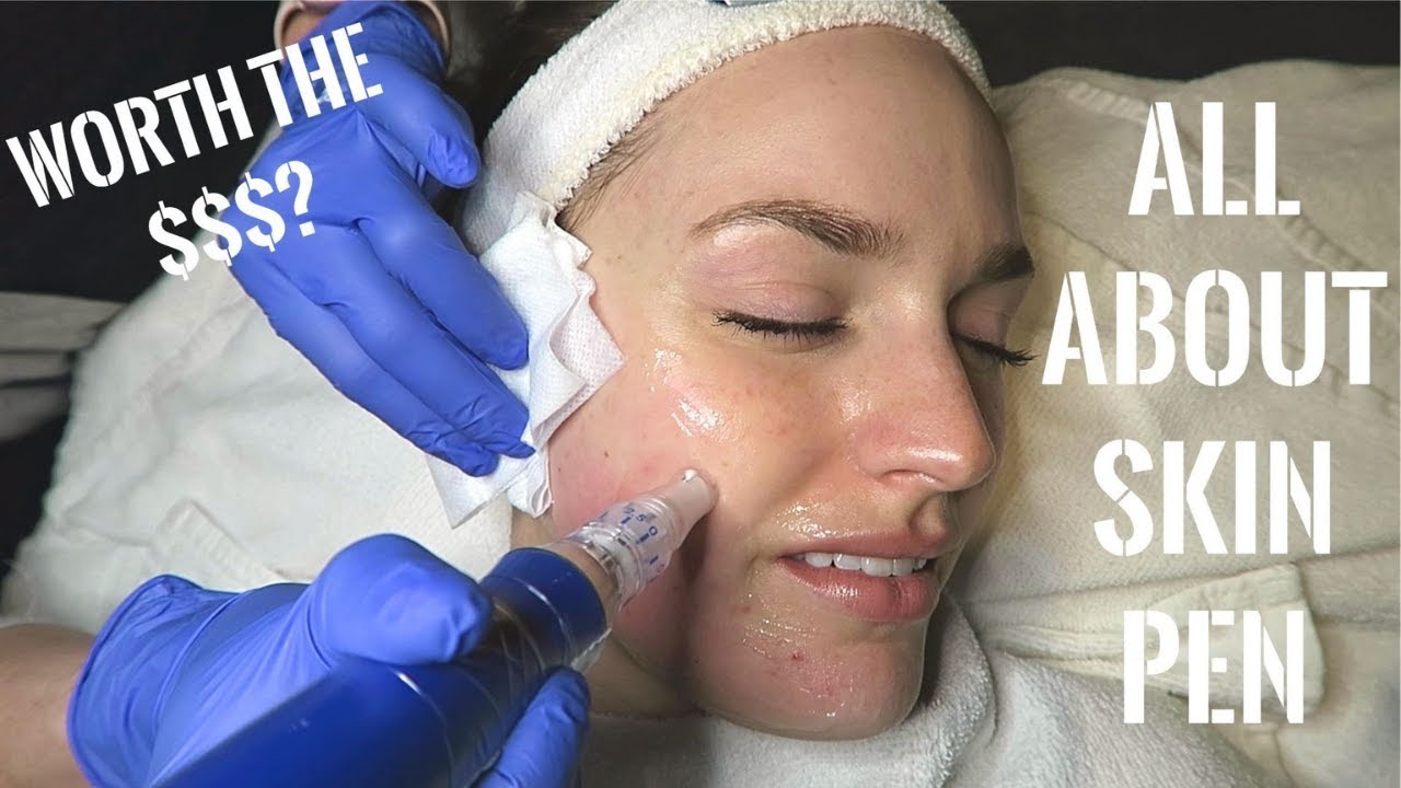 My First Skin Pen Treatment! Worth It?