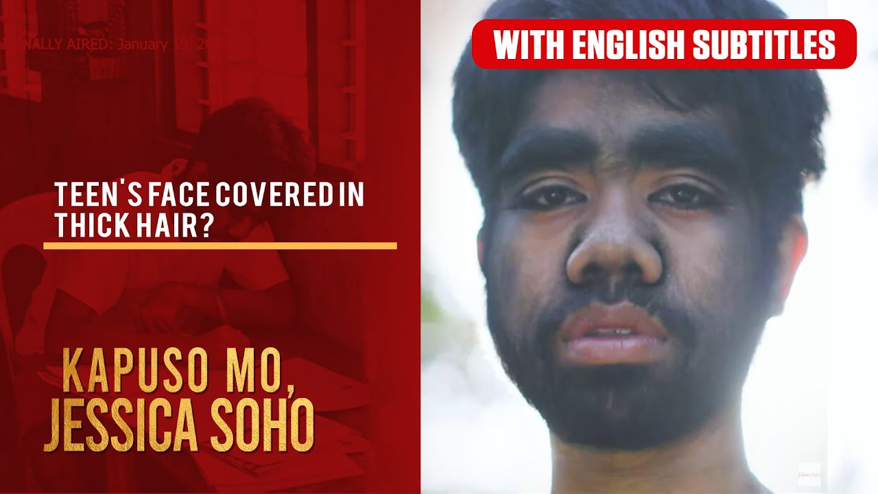 Teen's face covered in thick hair? (with English subs) | Kapuso Mo, Jessica Soho