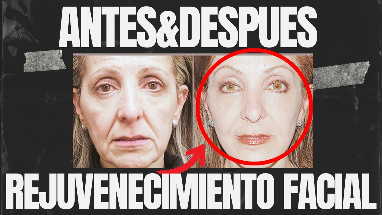 ✨Rejuvenecimiento FACIAL sin CIRUGIA ( SIN ARRUGAS )🌟 ► METODO YUEN REJUVENECIMIENTO FACIAL