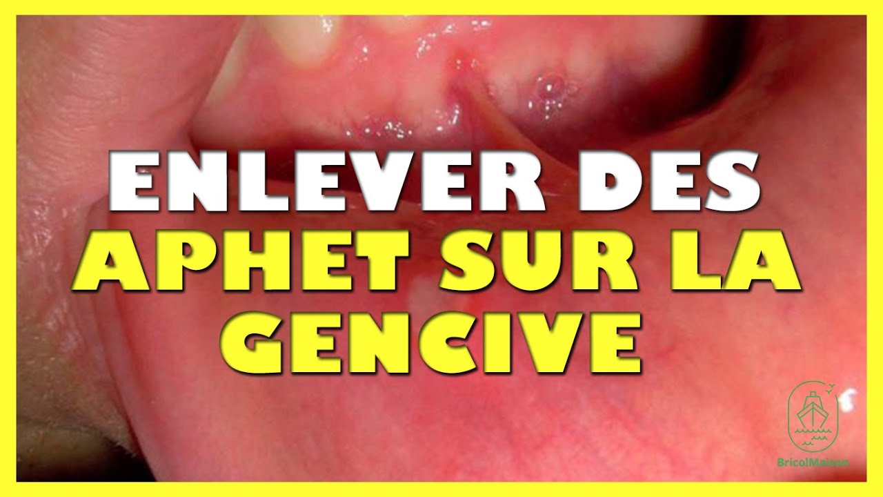 Comment enlever un aphte sur la gencive