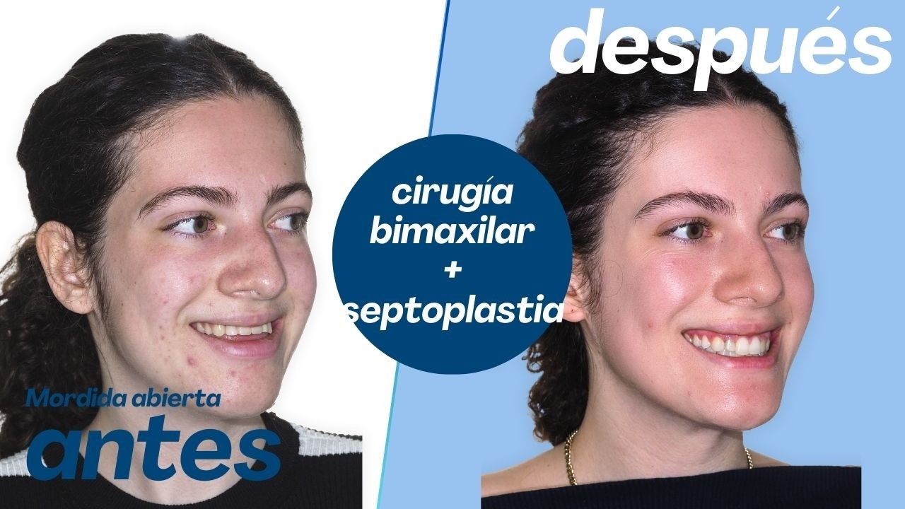 Cirugía bimaxilar Caso #177: Elena - Mordida abierta, Hiperplasia maxilar, Biretrusión