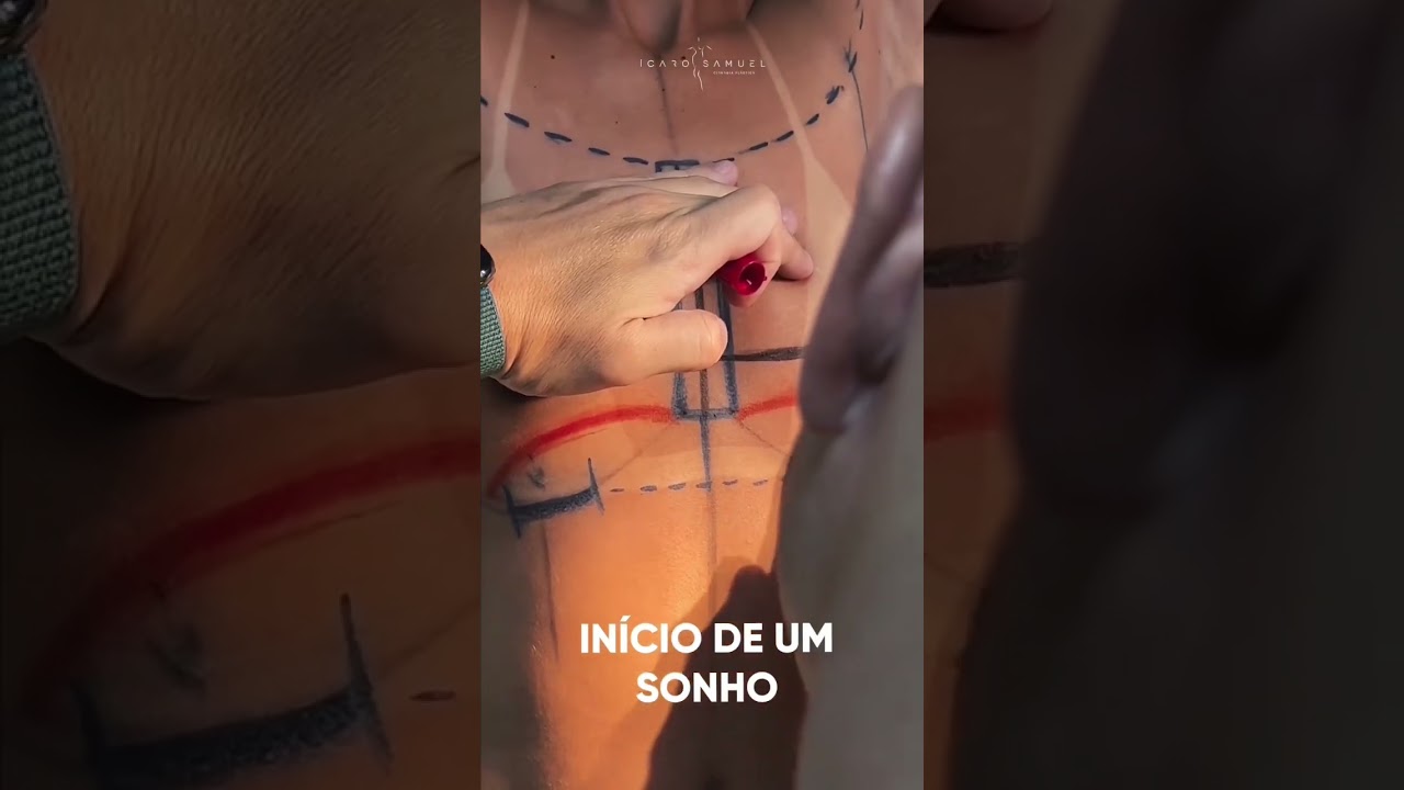 37 ANOS CASADA E UM SONHO TER UM DECOTE E UMA MAMA LINDA - CIRURGIA PL&Aacute;STICA