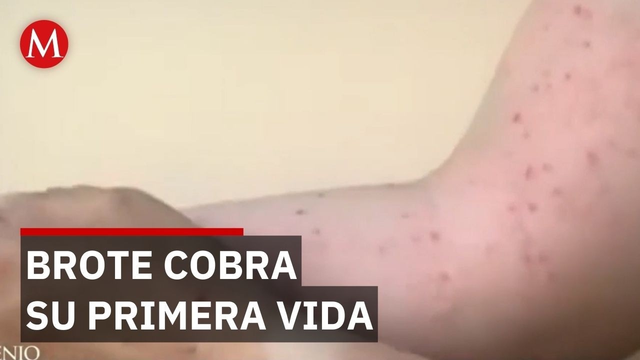 Secretaría de Salud confirma primera muerte por sarampión en CdMx