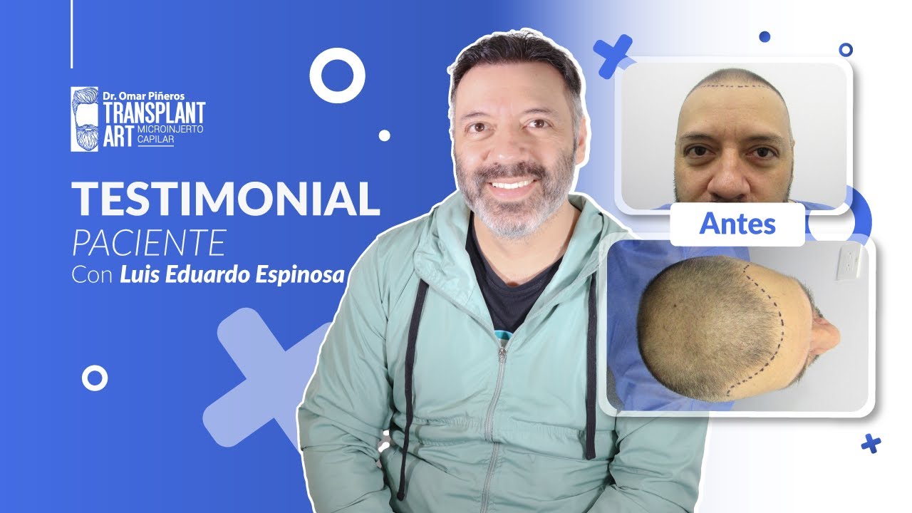 🤯 5 MESES DESPUÉS DEL TRASPLANTE CAPILAR - LUIS EDUARDO ESPINOSA