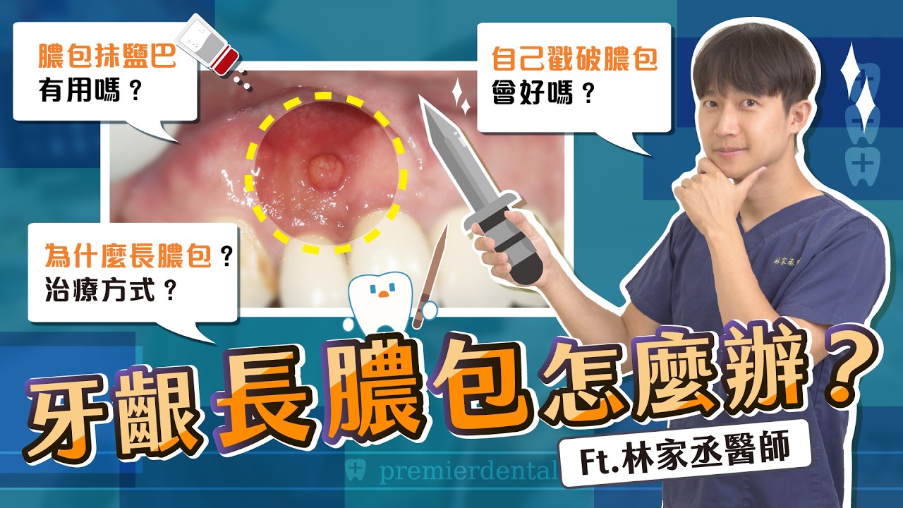 ＜牙齦膿包Q&A＞長膿包病因與治療方式？抹鹽巴在膿包有用嗎？自己戳破膿包會好嗎？ Ft.林家丞醫師【品悅牙醫】