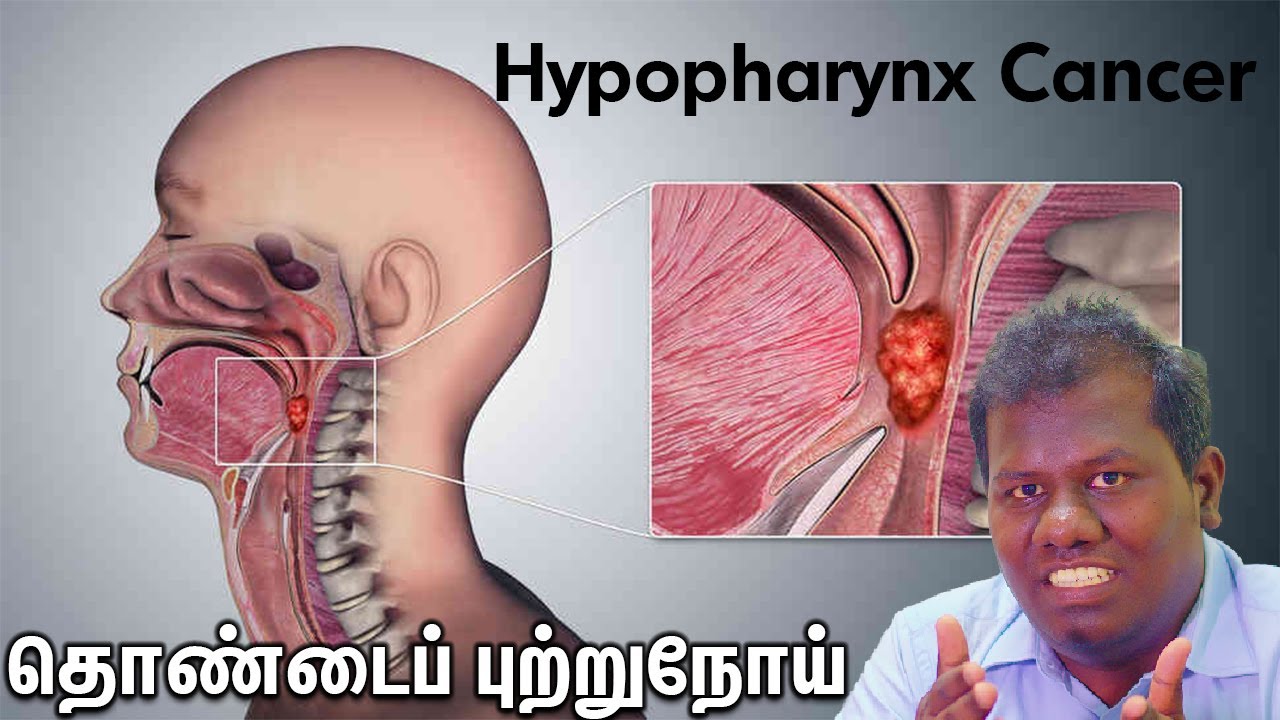 Hypopharynx cancer | தொண்டைப் புற்றுநோய் Dr.Narendran