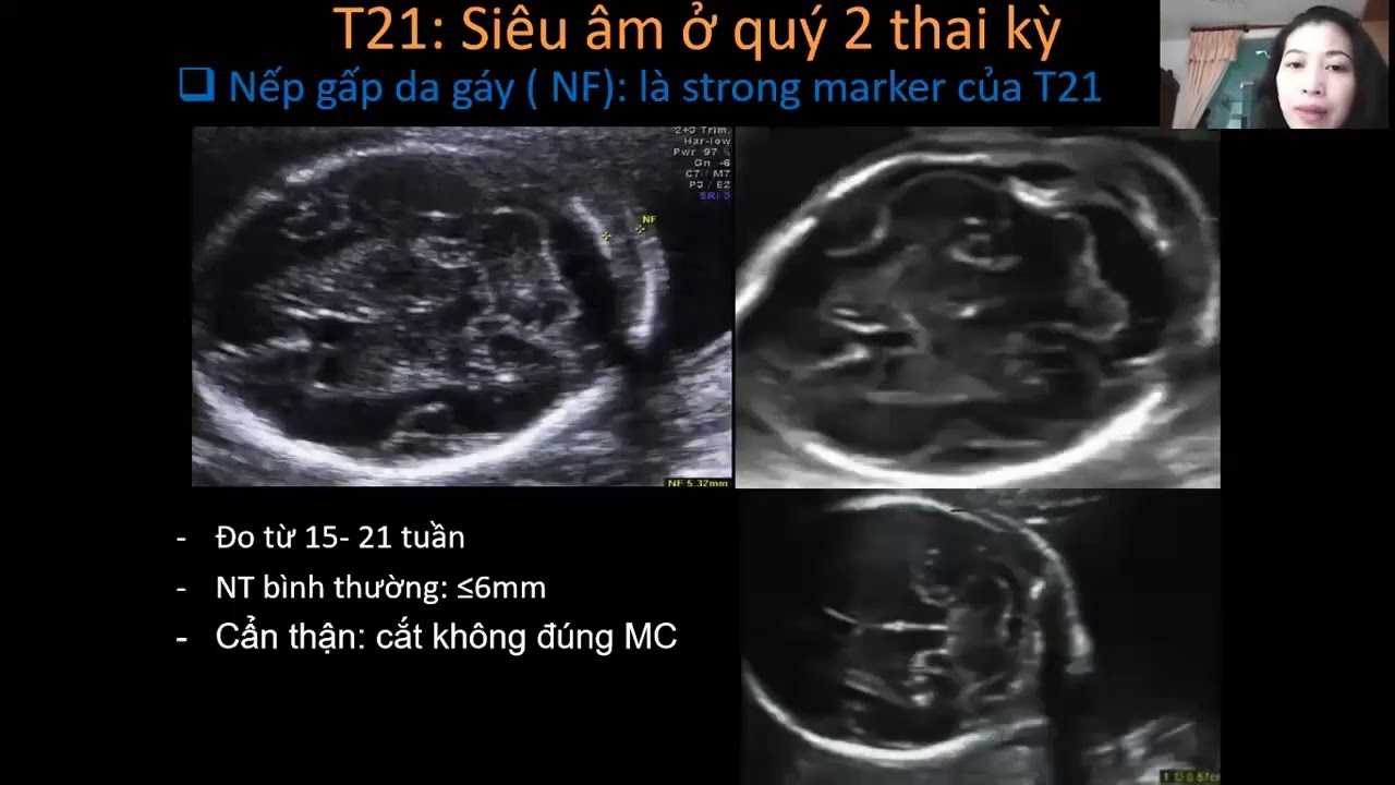 16 Siêu âm đánh giá một số bất thường nhiễm sắc thể thường gặp - ThS.BS. Ngô Thị Kim Loan