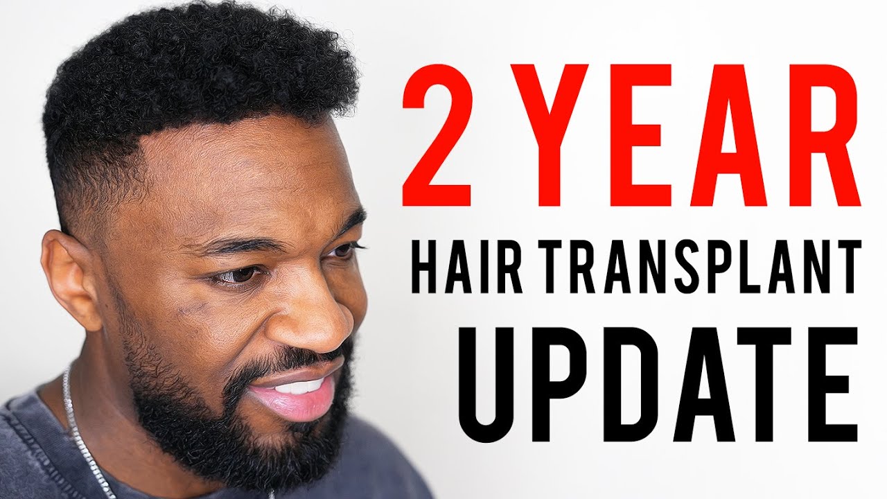 2 Year Hair Transplant Update & New Hair Journey with Copenhagen Grooming!