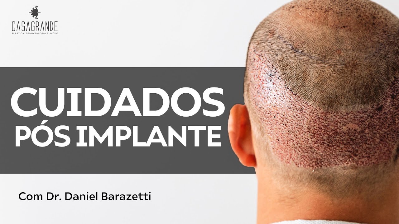 CUIDADOS APÓS O TRANSPLANTE CAPILAR