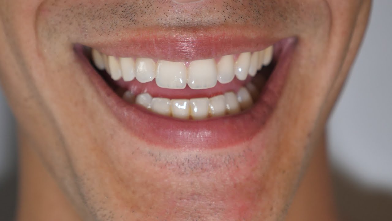 Understanding No Prep Veneers: What You Need to Know