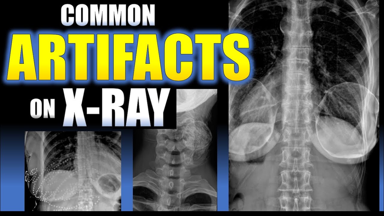 Common Artifacts on X-Ray