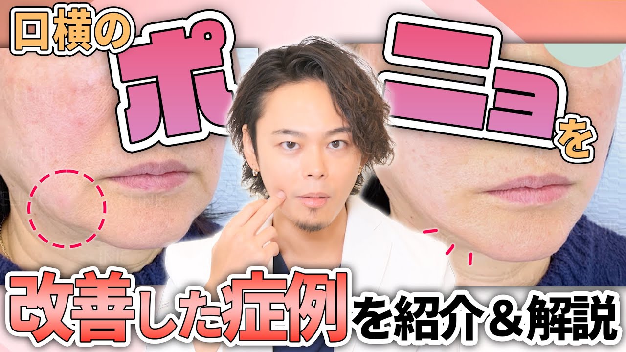 【たるみ改善】口横のポニョの4つの原因と改善した症例を紹介します