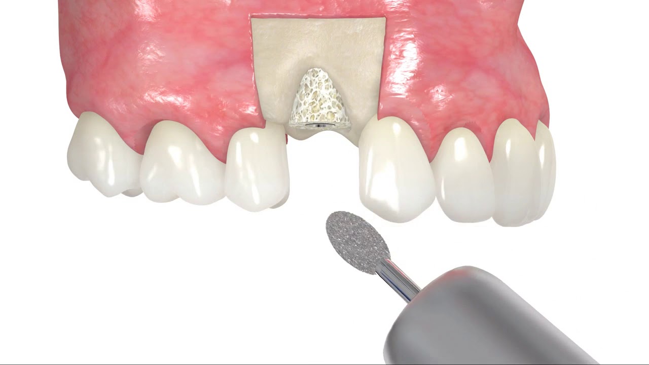 Augmentacja kości przy pomocy maxgraft bonering