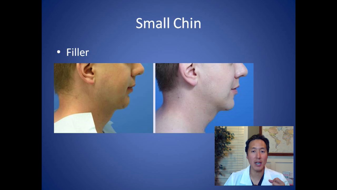 How Can I Make my Chin Larger - Chin Implant Consultation - Dr. Anthony Youn