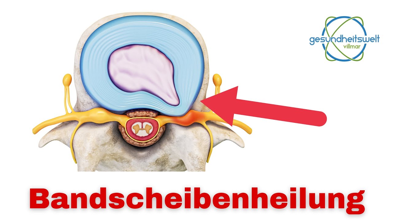 Heilung nach Bandscheibenvorfall