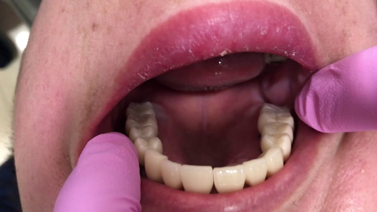 All on 8 Dental implant video 1