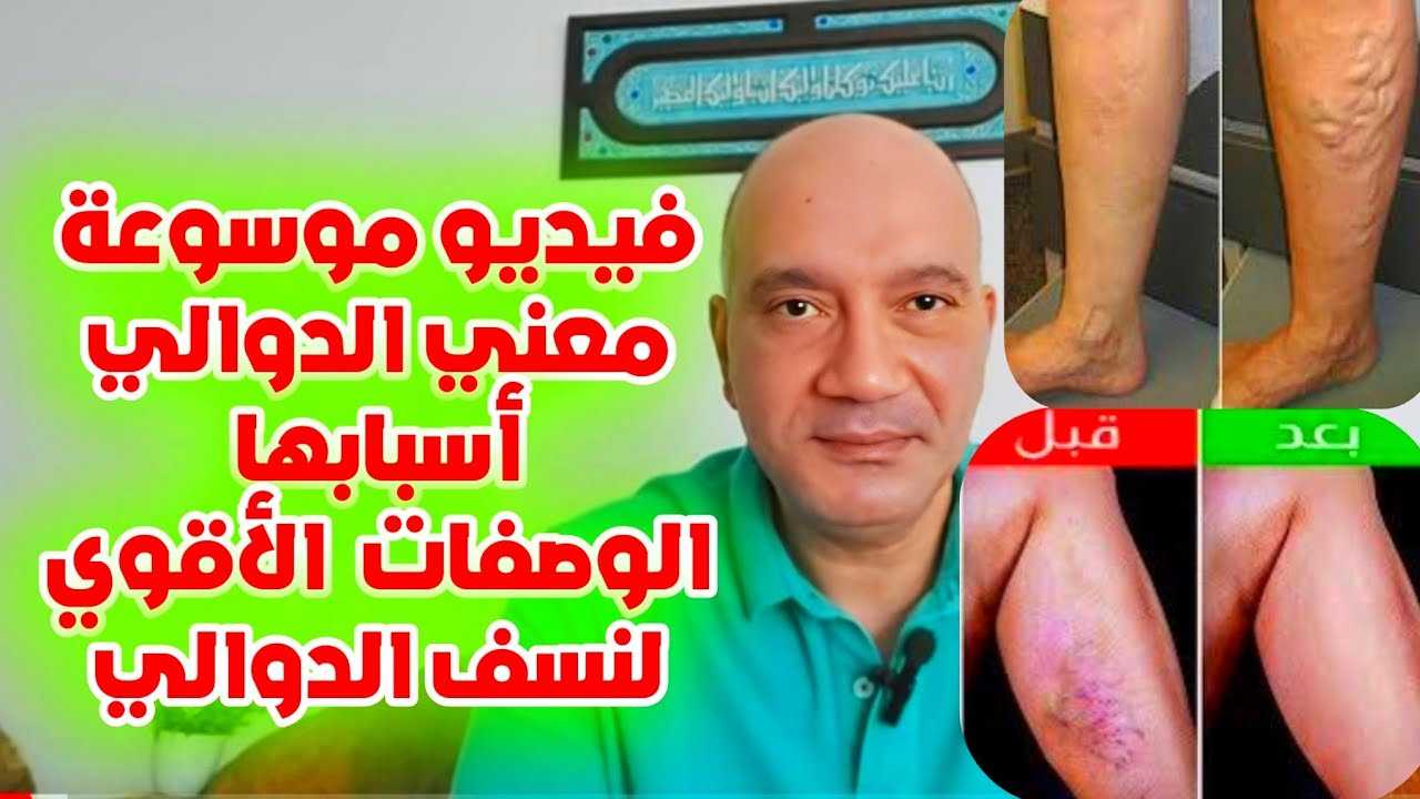 وصفات طبيعية قوية للدوالي (الأوردة العنكبوتية)
