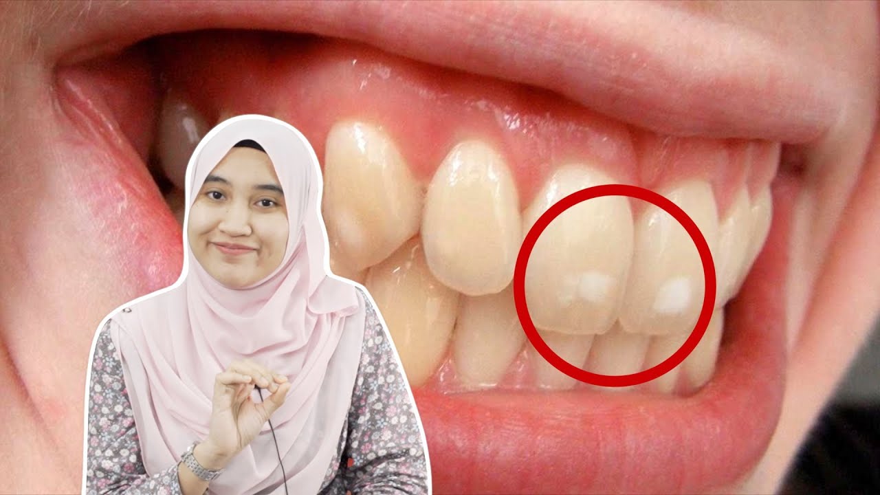 Apa Tompok Putih Dekat Gigi Tu?