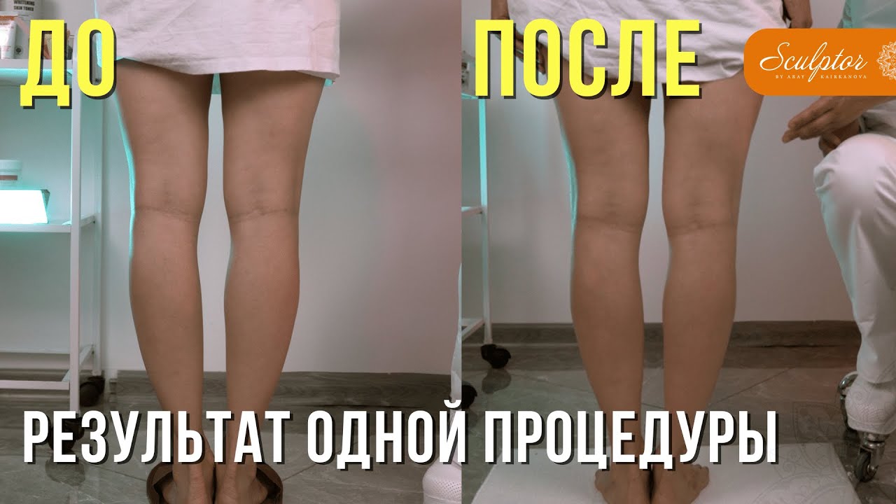 Выравниваем О-образные ноги! Показываем техники для выпрямления ног.