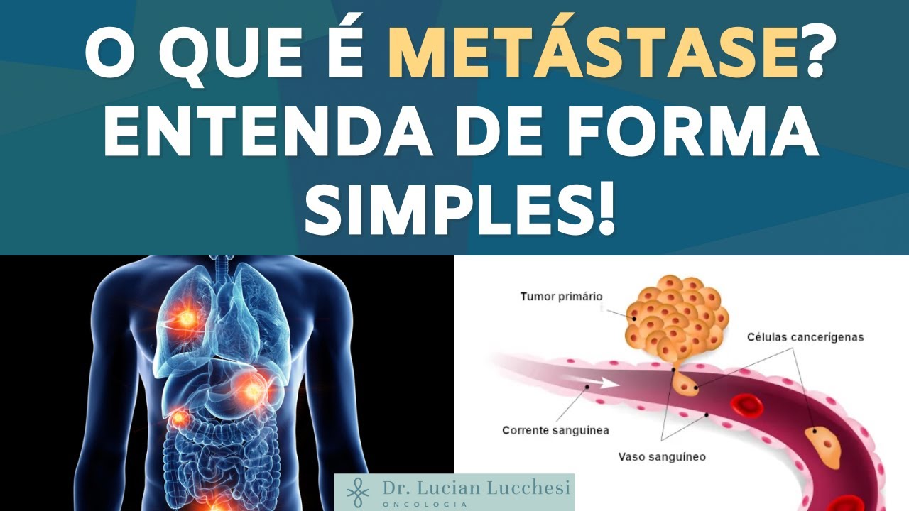 O que é Metástase? Entenda de Forma Simples!
