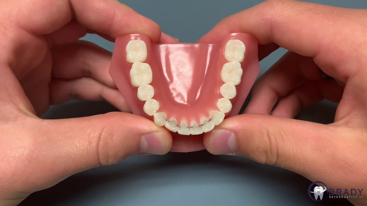 Taking Care of Retainers, SureSmile Aligners, and Invisalign Trays