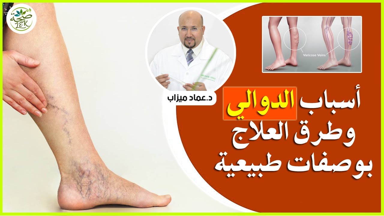 سبب ظهور الدوالي وطرق العلاج مع الدكتور عماد ميزاب Dr imad mizab