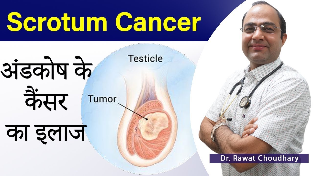 अंडकोष के कैंसर का इलाज | Scrotum Cancer Treatment | Testicular Treatment